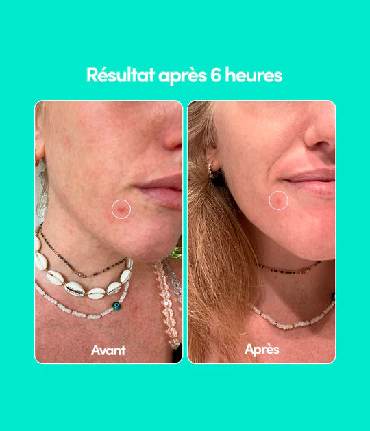 MERCI HANDY Pimple patches (24 patches)